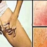 What Vitamin Deficiencies May Lead to White Spots on the Skin