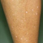 ⚠️ CRITICAL ALERT: If You See These Red or Purple Spots on Your Skin, It Could Signal a Serious Vascular Condition