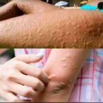 Ginger: A Powerful Root with Key Precautions for Certain Conditions