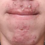 Hands Falling Asleep at Night? Paresthesia: Causes and Solutions